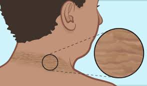 Ảnh 4 của Acanthosis Nigricans